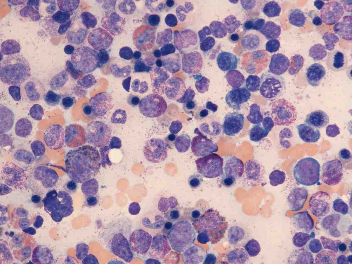 2012 aspirate smear 100X